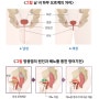 방광염 '가장흔한 원인 장내세균 80%' 증상과 예방법은?