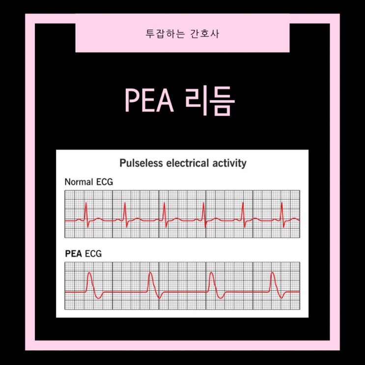 Asystole , PEA , TTM 의학용어 알아볼게요. : 네이버 블로그