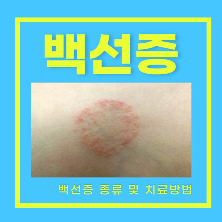 완선 체부 백선 백선증 종류 및 원인 치료방법 : 네이버 블로그