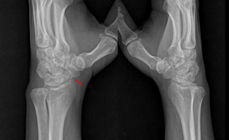주상골 불유합(scaphoid nonunion)에서 시행한 자가 장골 골이식술을 동반한 골유합술 (Osteosynthesis ...