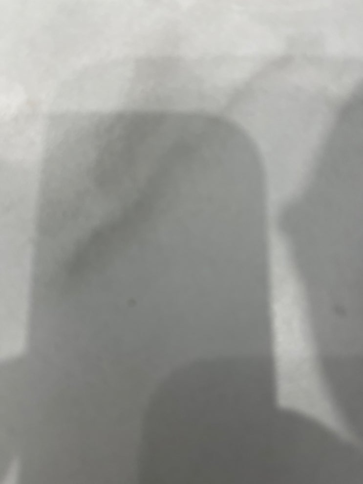 손가락 마디 통증 부음 원인 종류 손가락 관절염 증상 염증 : 네이버 블로그
