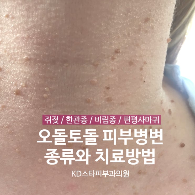 피부에 오돌토돌, 쥐젖 한관종 비립종 편평사마귀_KD스타피부과 : 네이버 블로그