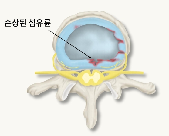추간판 탈출, 디스크증상, 척추전방전위증 묵동한의원 치료 : 네이버 블로그