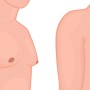 가슴 축소 수술/시술, 남자(여유증)와 여자(크고 처진 가슴) 치료 방법 차이는?