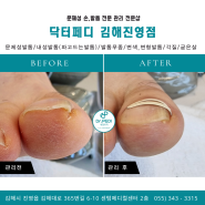 김해내성발톱, 창원내성발톱 해결