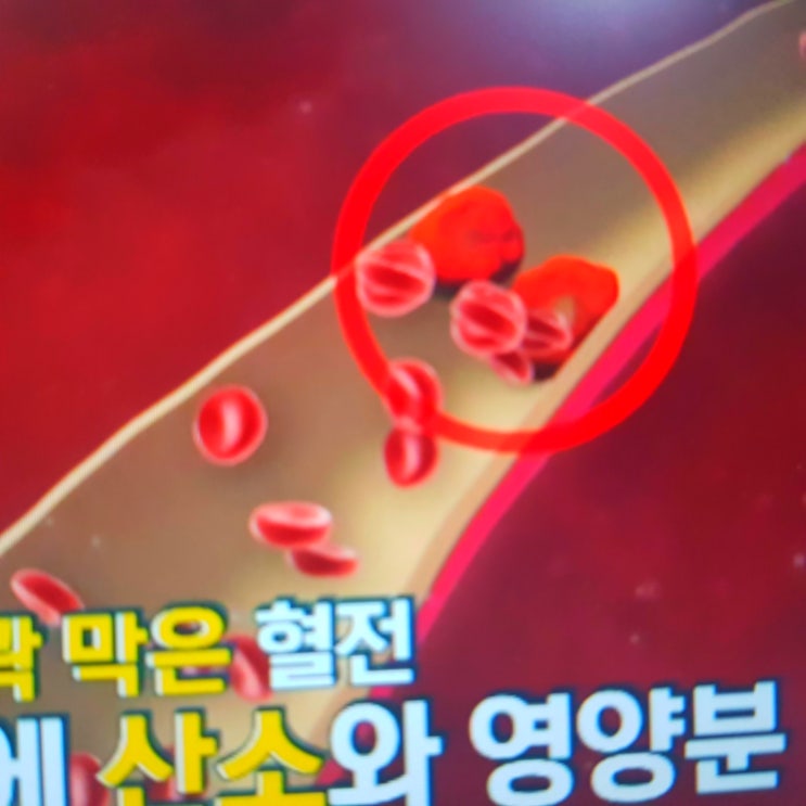 혈전이란 뜻은? 다리 혈전, 혈전색전증? (ft. 혈전약) : 네이버 블로그