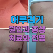 어루러기 원인과 증상,치료,전염,피부곰팡이균 알아보기