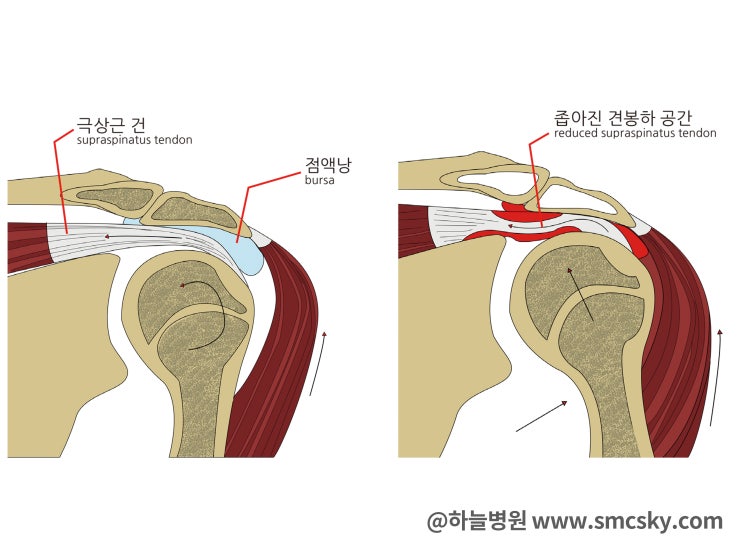 어깨 석회성건염 증상 및 치료, 통증 원인(극상근 힘줄염, 시술) : 네이버 블로그