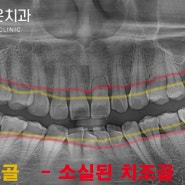 영등포동 임플란트 받고 치아 흔들림이 사라졌어요!