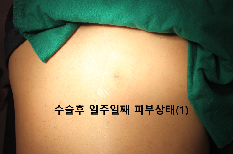 등 표피낭종 수술, 그리고 최소화된 흉터 : 네이버 블로그 등 표피낭종 수술, 그리고 최소화된 흉터 : 네이버 블로그