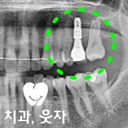 임플란트 공간 부족할때 하는 치아교정(with 옳소플란트)