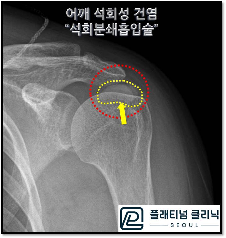 (플래티넘의원) 석회성 건염 치료의 진실.