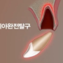 여름철 물놀이 사고 : 외상으로 인한 치아 파절 및 치아 탈구