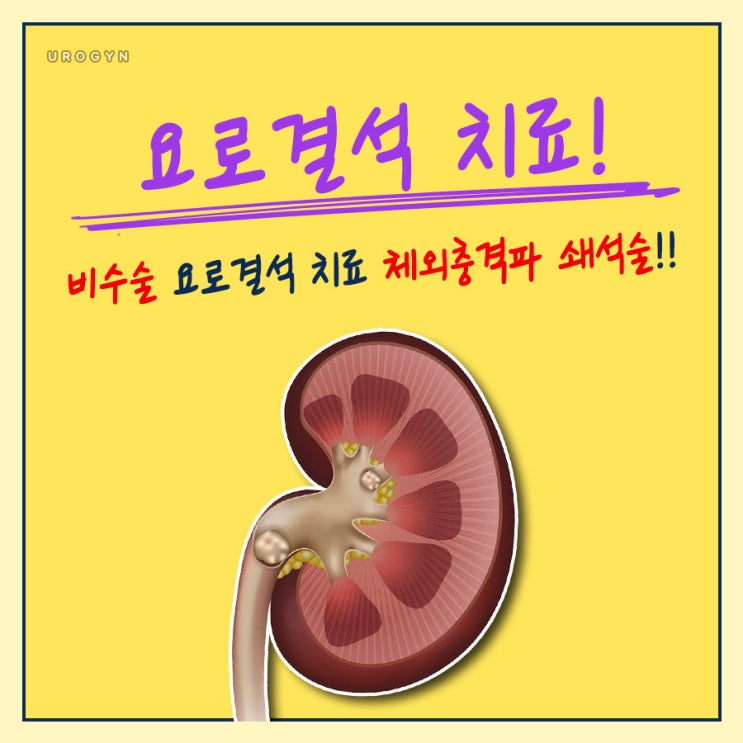 비수술 요로결석치료인 체외충격파치료에 대해 : 네이버 블로그