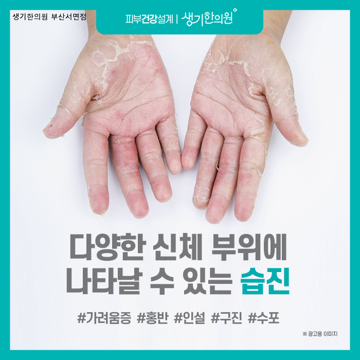부산 습진, 다양한 신체 부위에 나타날수 있는 습진! : 네이버 블로그