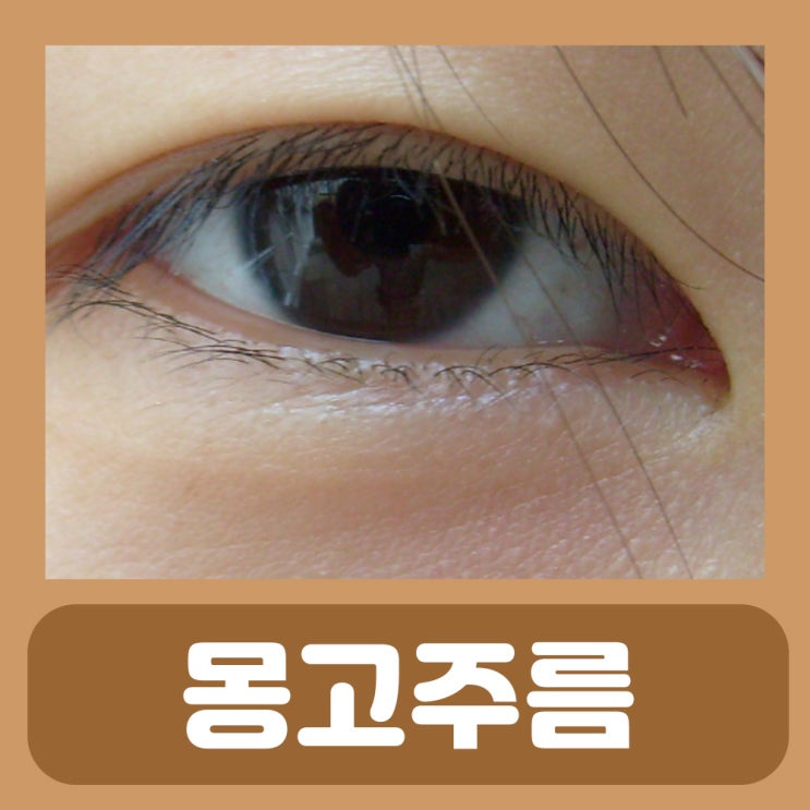 쌍수 눈 몽고주름 제거 방법 : 네이버 블로그