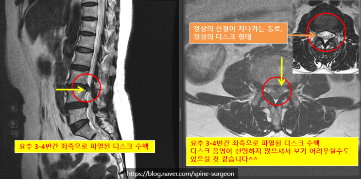 왼쪽 서혜부 쪽부터 정강이 앞, 옆쪽이 저리고 아파요 (양방향내시경을 이용한 요추 3-4번 좌측 추간판 수핵탈출증 수술 ...
