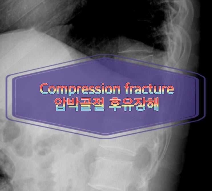 넘어지는 사고로 발생한 압박골절 진단으로 입원치료 후 상담 요청한 사례 제12흉추 압박골절 T12 compression ...
