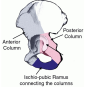 비구골절(Acetabular Fx.) (1)