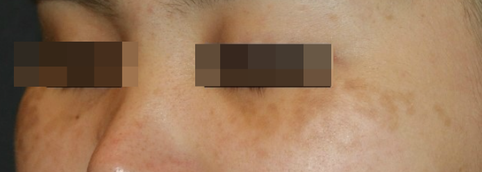 기미일까요? 혹시 오타양반점(ABNOM) ?? : 네이버 블로그