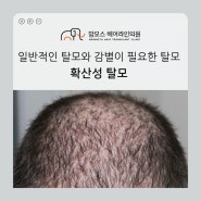 확산성 탈모(Diffuse alopecia, 미만성 탈모증)의 정의와 원인, 치료