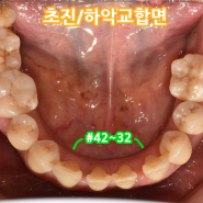 달서구 치과 앞니 벌어짐 다이아스테마 및 어금니 임플란트 수술 사례