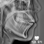 턱관절통증 호소한 무턱 개방교합 치아재교정 사례