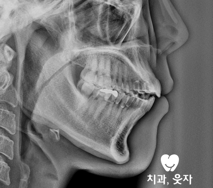 턱관절통증 호소한 무턱 개방교합 치아재교정 사례 : 네이버 블로그
