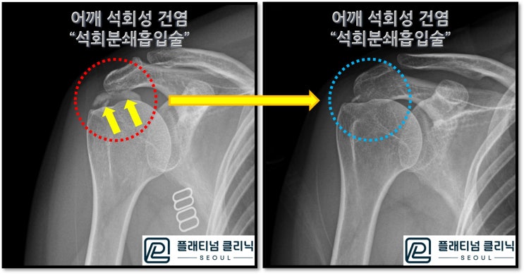 (플래티넘의원) 어깨 석회성 건염. 수술없이 치료하는 석회분쇄흡입술.