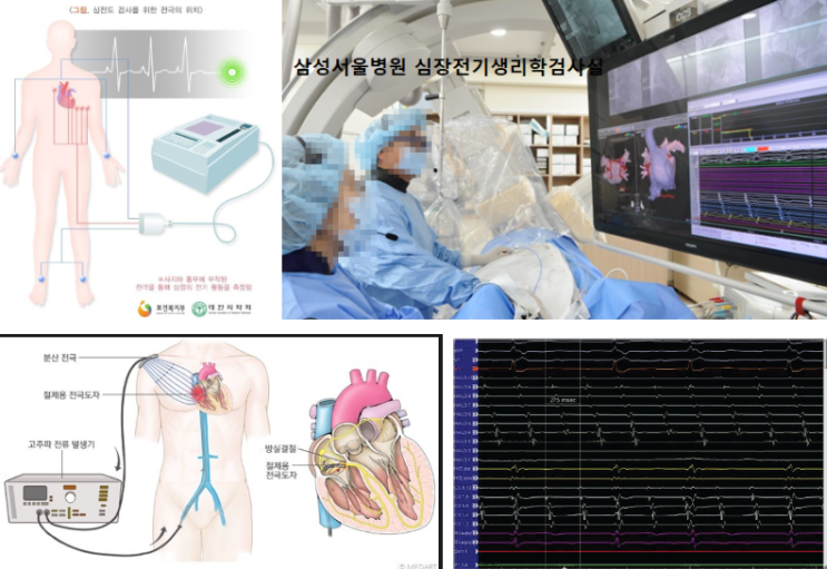 혈관조영실 입문_Ch24 전극도자절제술(RFCA, RadioFreqency Catheter Ablation) : 네이버 블로그