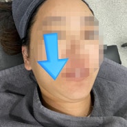 홍대 합정 수면 울쎄라! 성형외과 전문의가 직접 시술한 내돈내산 FLEX