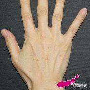 손등 검버섯(일광흑자)제거 레이저치료 ::: 부천 더피부과