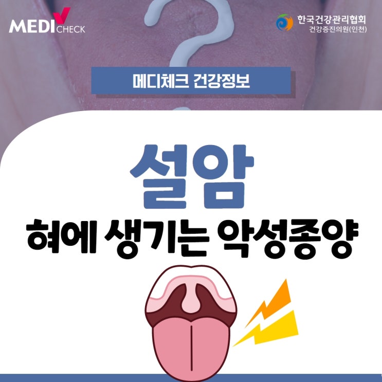 악성종양, 혀에도 생길 수 있어요! 설암 초기증상 : 네이버 블로그