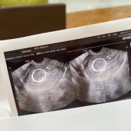 [임신 일기 10]임테기 역전안했는데 아기집 확인?그리고 임신 극초기 증상