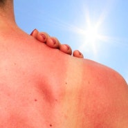 여름철 피부 망치는 생활습관 / 피부열 내리는 방법