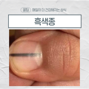 손톱, 발톱 검은 세로줄 흑색종 증상 구별방법