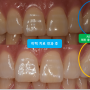 49 - 이가 누렇고 패어있어요 : 치아미백과 치경부 마모증 레진 충전치료로 밝고 환한 미소 찾아드리기