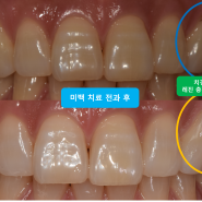 49 - 이가 누렇고 패어있어요 : 치아미백과 치경부 마모증 레진 충전치료로 밝고 환한 미소 찾아드리기