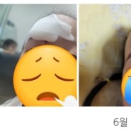 한강수병원 아기 미간 열상, 찢어짐 재봉합합 후 흉터 관리 중