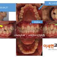 비발치.돌출케이스 - 이세현교정치과/대전치아교정전문