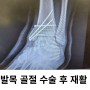 [평촌PT, 평촌재활]발목 골절 수술 후 재활