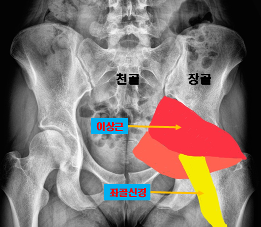 이상근증후군 병원, 엉치 골반 통증이 너무 아파요 : 네이버 블로그