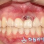 가정동치과, 인천치아깨짐 외상으로 인한 치근파절된 상악 전치부 치아의 임플란트 치료가 아닌 자연치아 보존적 치료 증례