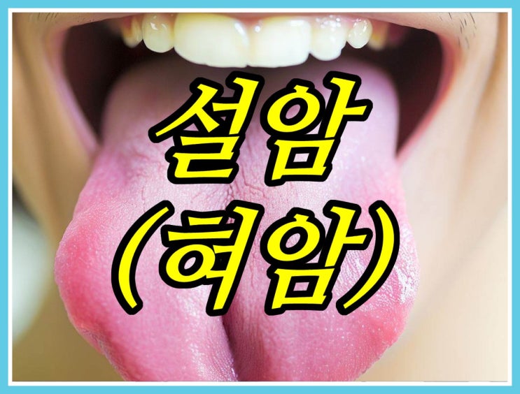 설암 원인 및 증상, 치료, 의심되면 꼭 병원가세요 : 네이버 블로그