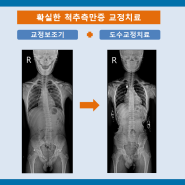 여름방학 척추측만증 교정치료, 양주아산재건정형외과