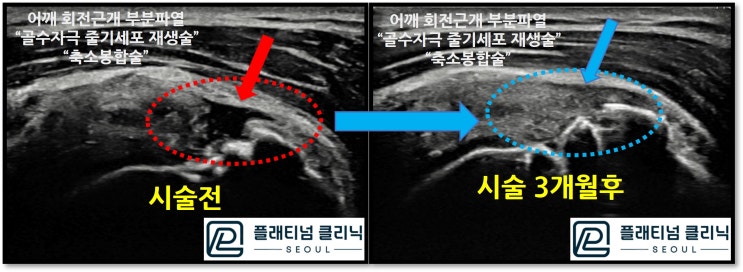 (플래티넘의원) 회전근개 파열, 수술없이 치료!!