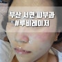 부산 서면에서 루비레이저 받고 기미 주근깨 뿌수고 왔다(1주차)