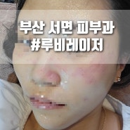 부산 서면에서 루비레이저 받고 기미 주근깨 뿌수고 왔다(1주차)