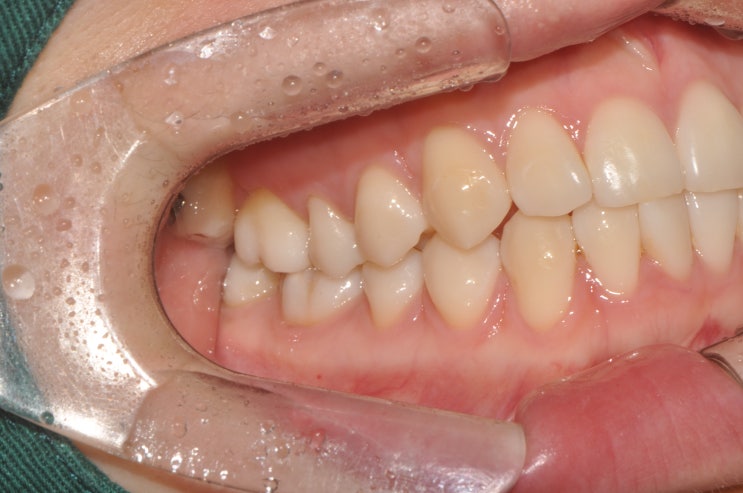 [교정과] 성인 양측성 시저바이트 치험례 (adult bilateral scissors bite orthodontic ...