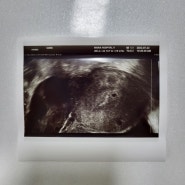 [임신일기] 5주0일 처음으로 본 초음파